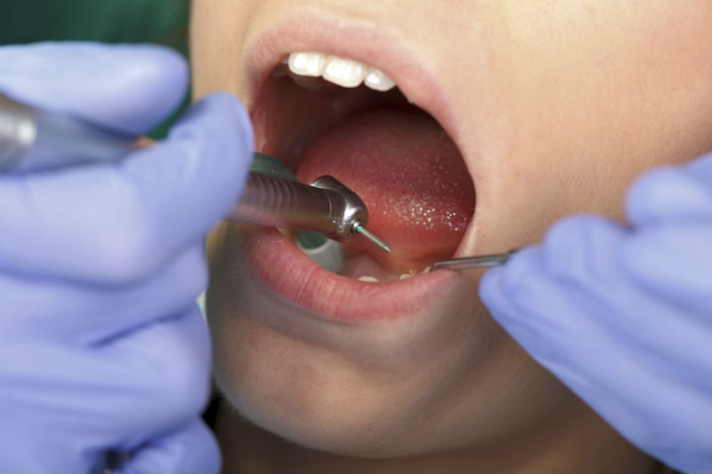 What Are the Leading Causes of Cavities?