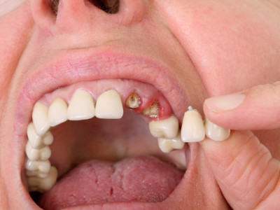 Do I Need A Prosthodontist?