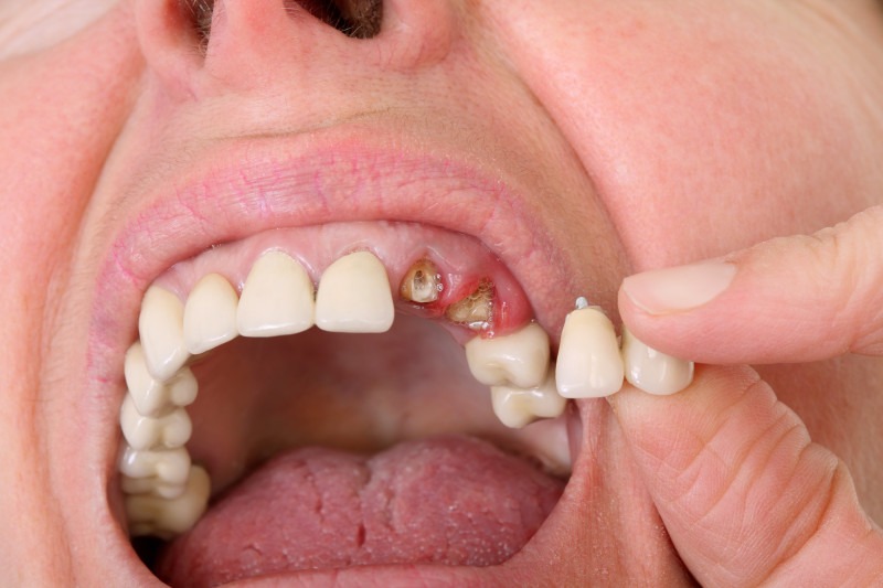 Do I Need A Prosthodontist?