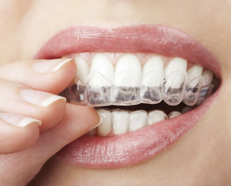 What is Oral Appliance Therapy?