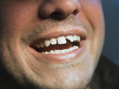 How to Fix a Chipped Tooth