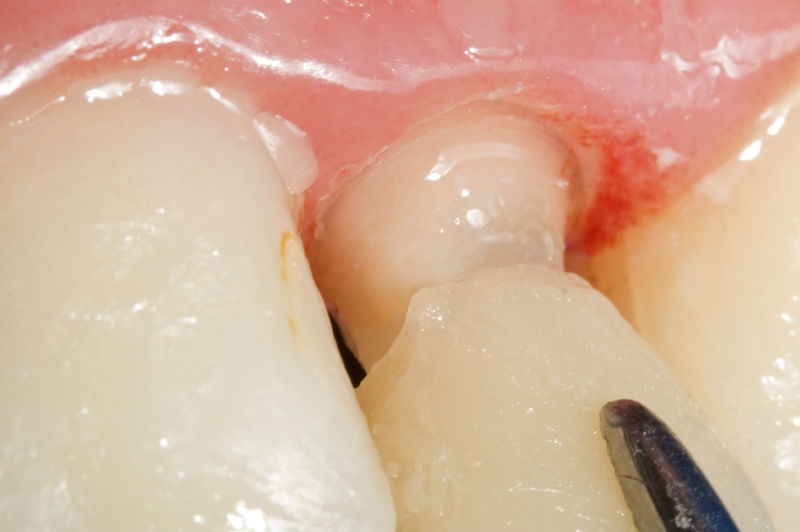 Filling, Crown or Dental Implant: Which Do I Need?