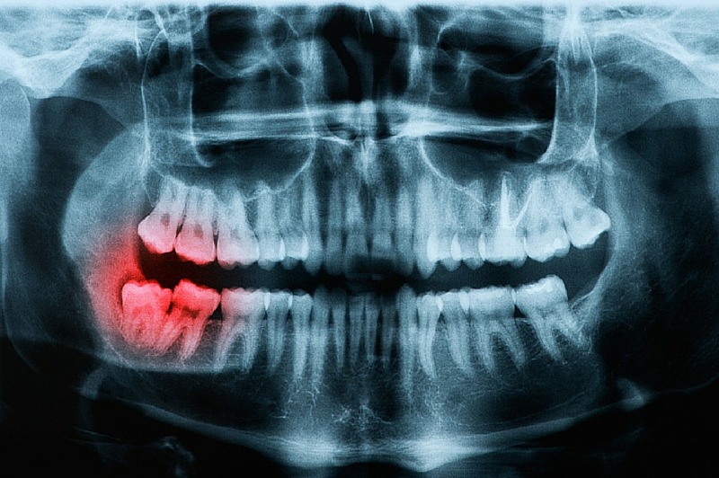 What Are Impacted Teeth?